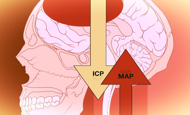 Cerebral Perfusion Pressure - an overview Cerebral perfusion pressure