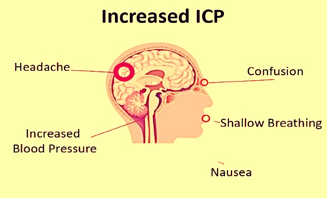 Increased Intracranial Pressure (ICP): an overview Intracranial Pressure